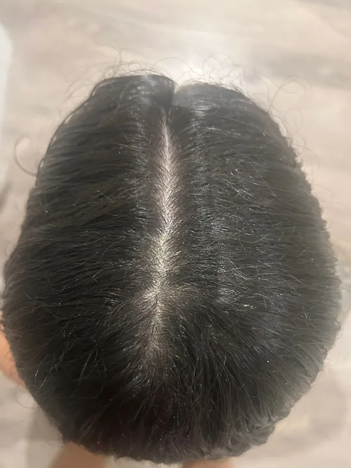 Después: el cuero cabelludo de Nerea, con el pelo visiblemente más denso y poblado en la raya, vista cenital